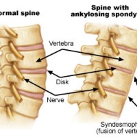 Homeopathy can cure Ankylosing Spondylitis